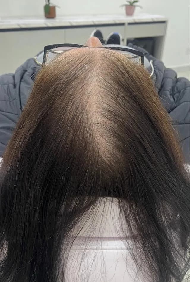 Couro cabeludo de paciente com alopecia androgenética: antes
