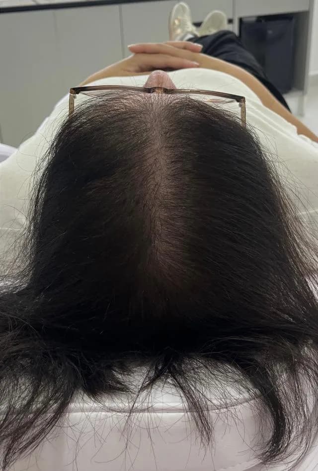 Couro cabeludo de paciente com alopecia androgenética: depois