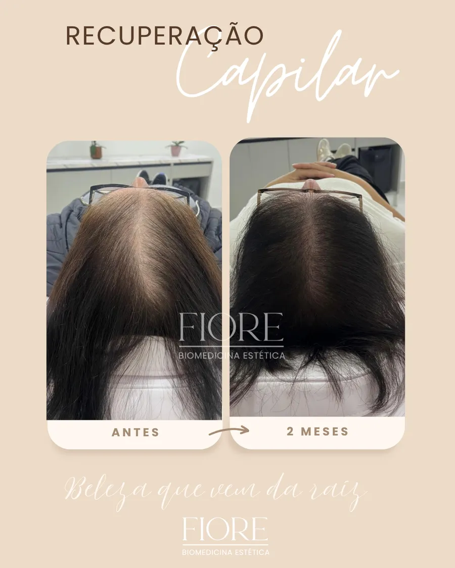 Antes e depois de recuperação capilar na Fiore