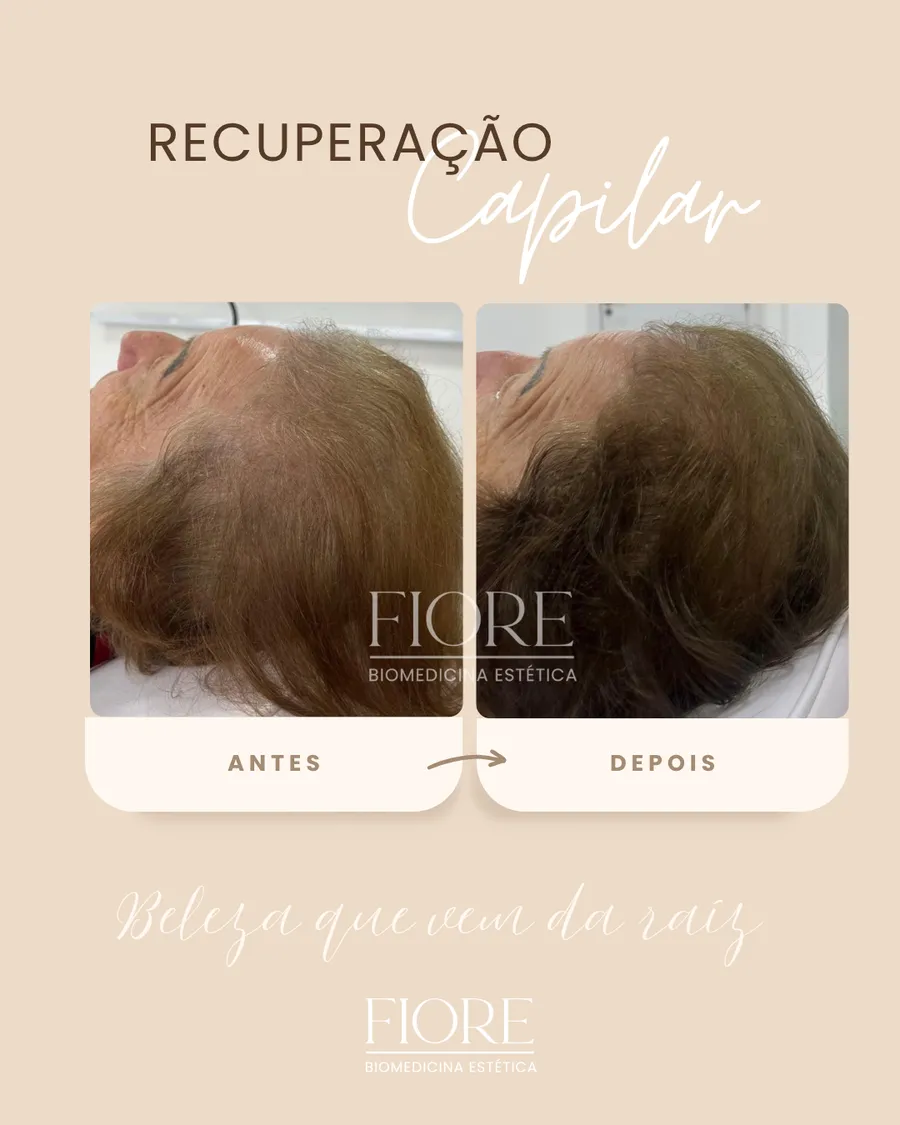Antes e depois de recuperação capilar na Fiore